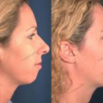 Chin Filler Before and After