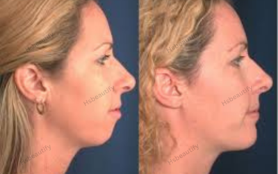 Chin Filler Before and After