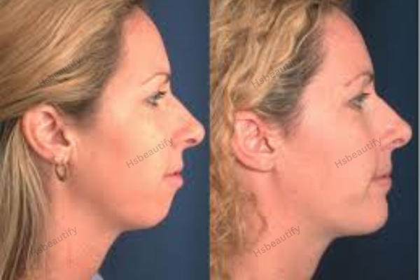 Chin Filler Before and After