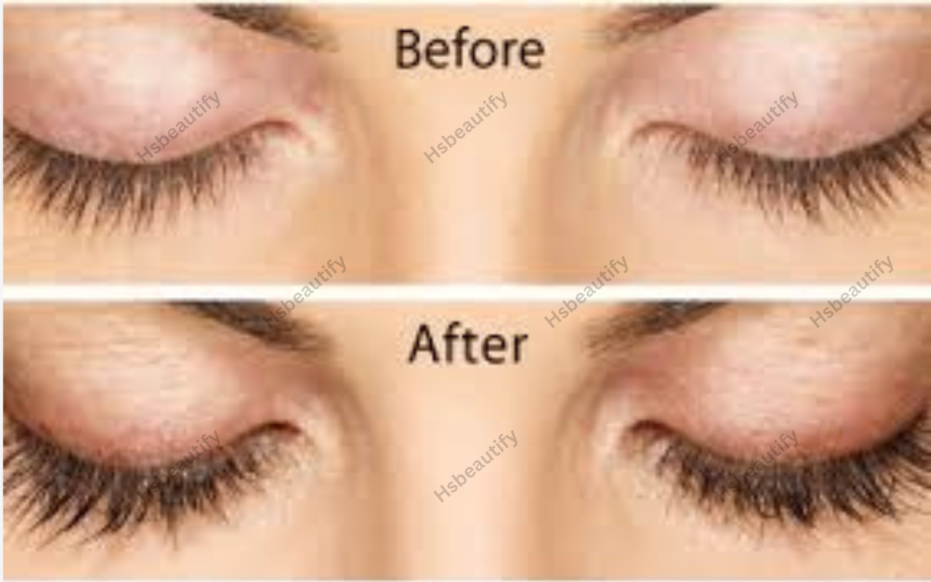 Latisse Eyelash Serum