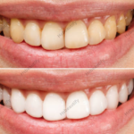 Teeth Whitening Before and After