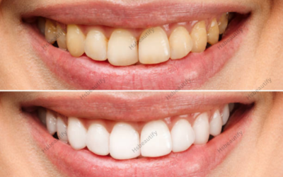 Teeth Whitening Before and After