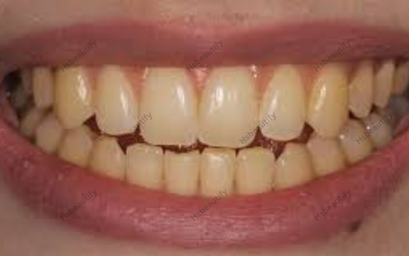 Teeth Whitening Before and After