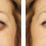 Undereye filler